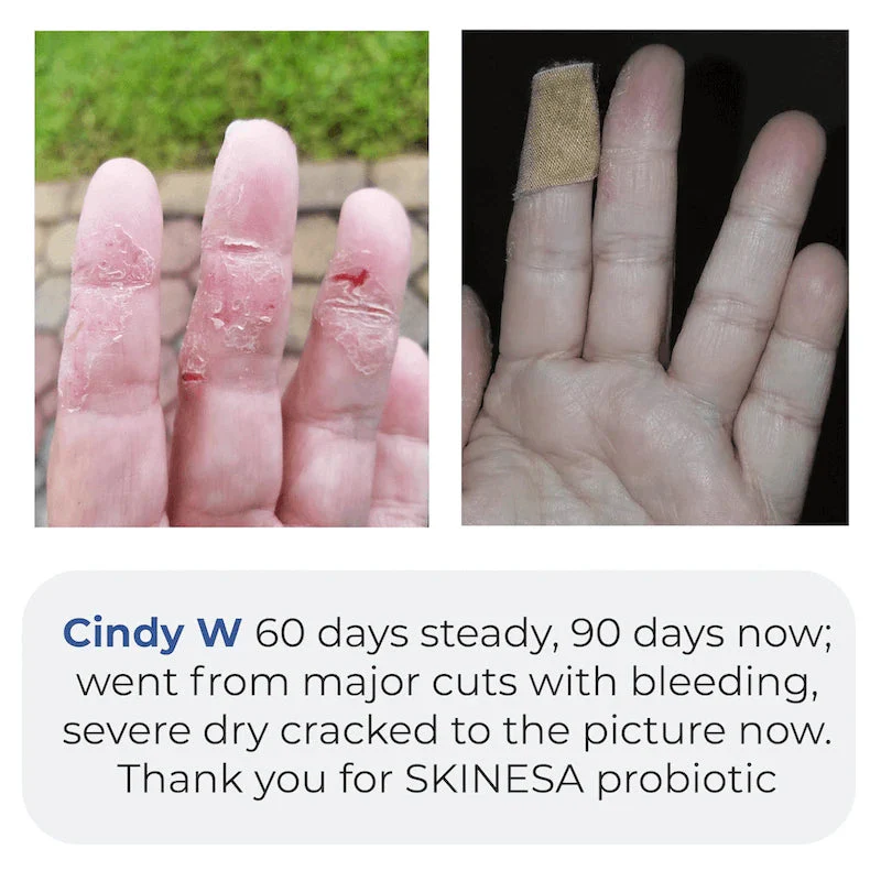 Skinesa® 30 Day Supply Subscription - Image 3